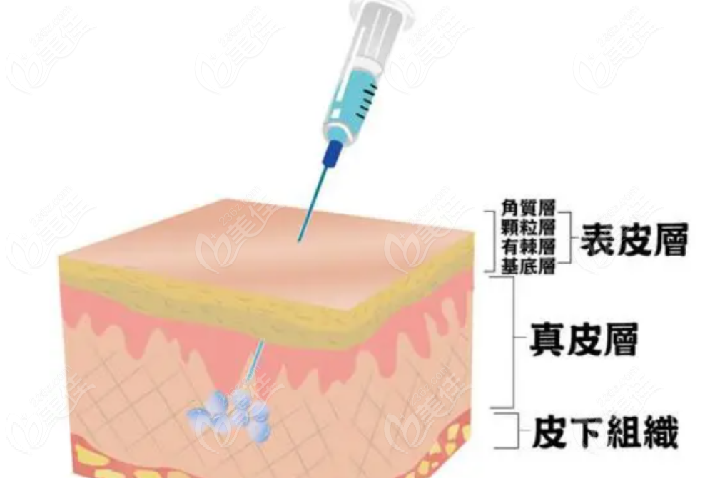 韩国DoctorPetit皮肤科玻尿酸注射