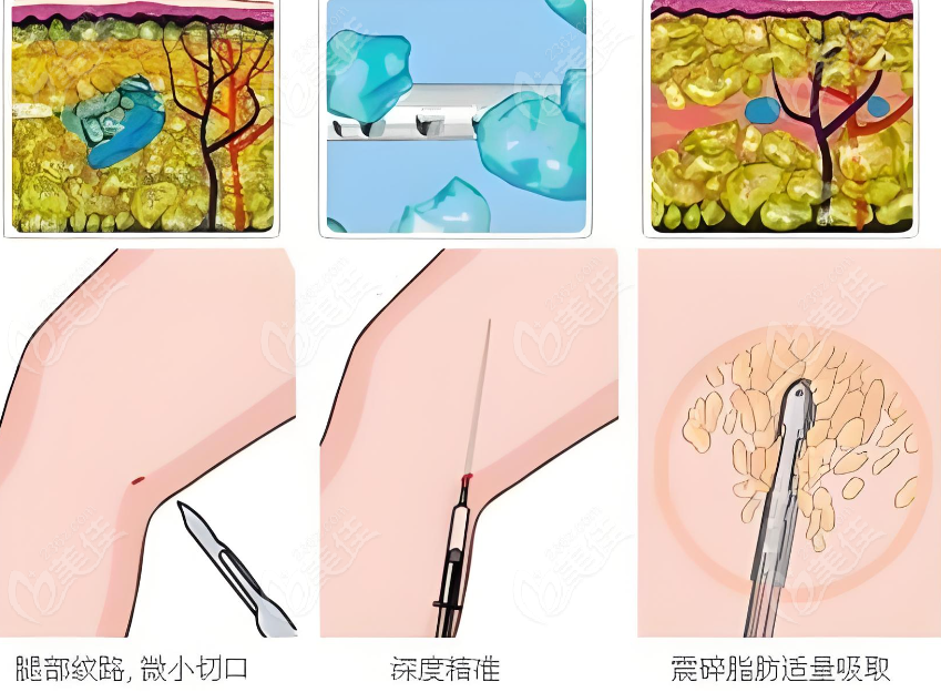 任学会做脂肪修复技术好