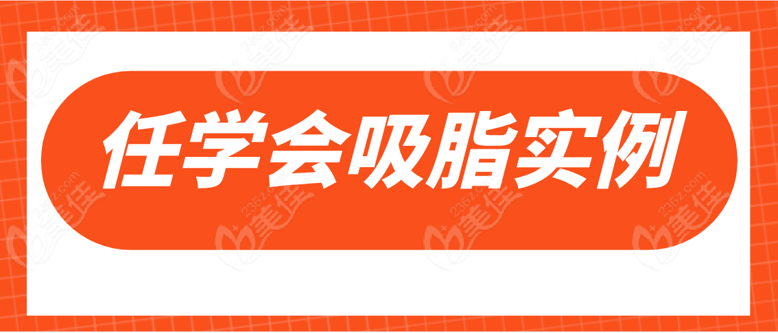 任学会吸脂实例分享