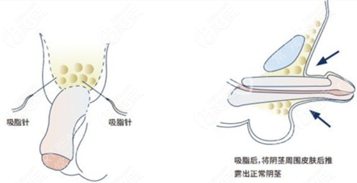 男性耻骨吸脂延长手术原理
