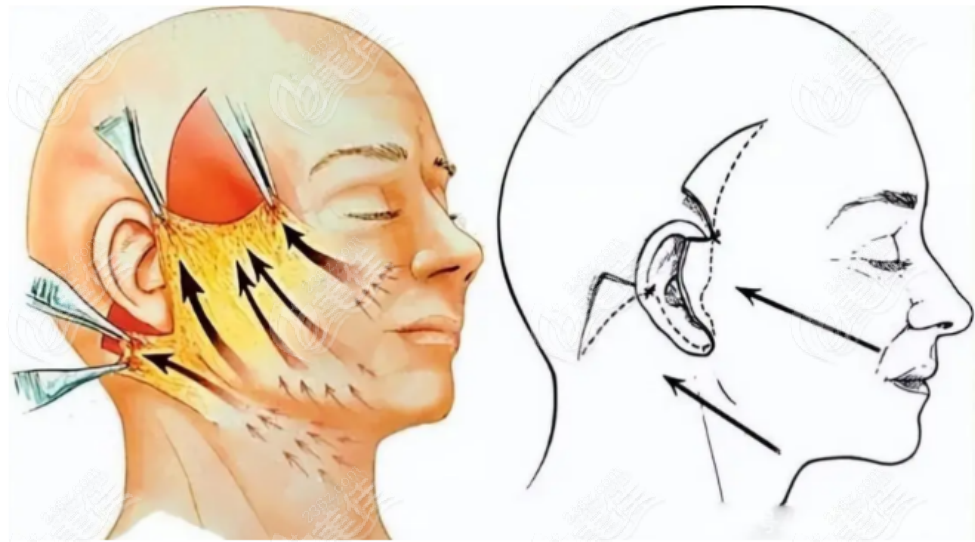 面部提升示意图