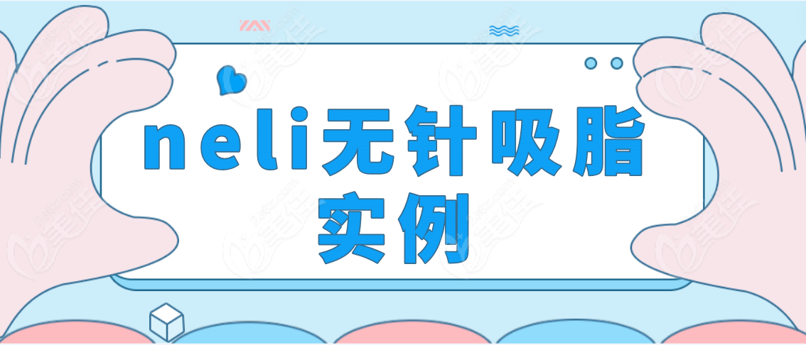 neli无针吸脂实例