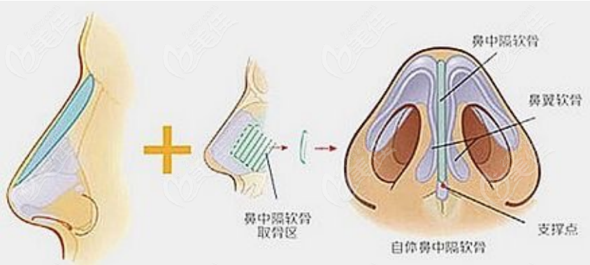 隆鼻手术示意图