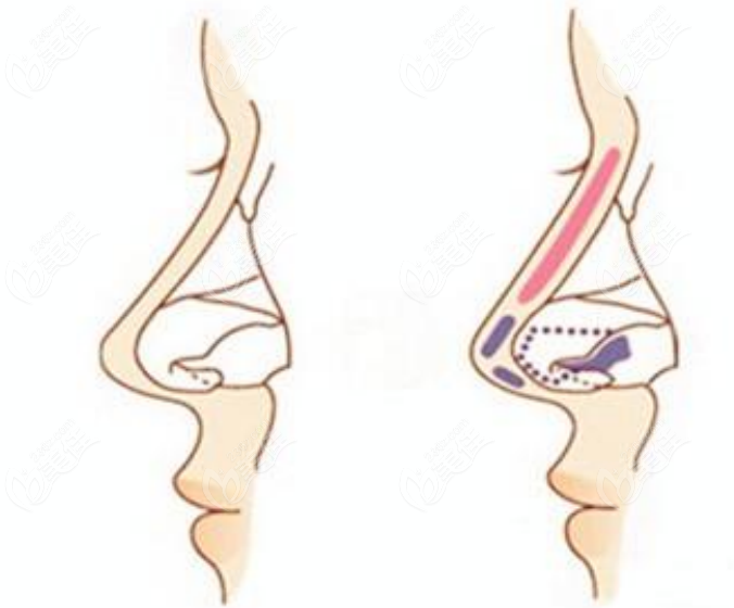 隆鼻手术示意图