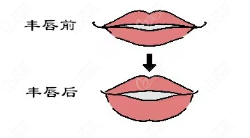 杭州豐唇崔晶瑩怎么樣?杭州維多利亞崔晶瑩打造嘟嘟唇飽滿自然可沖! 美佳網(wǎng)