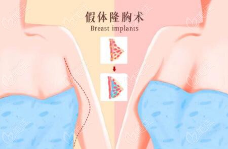 廣州華美王洪勇醫(yī)生隆胸怎么樣