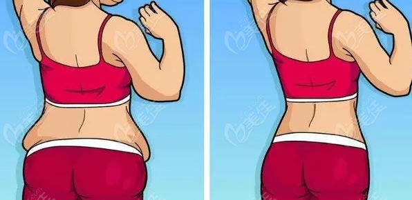 m.23美@佳6z.co/m成都李獻(xiàn)和腹壁成行術(shù)怎么樣?四川現(xiàn)代醫(yī)院李獻(xiàn)和腹壁整形疤痕小疼痛感低