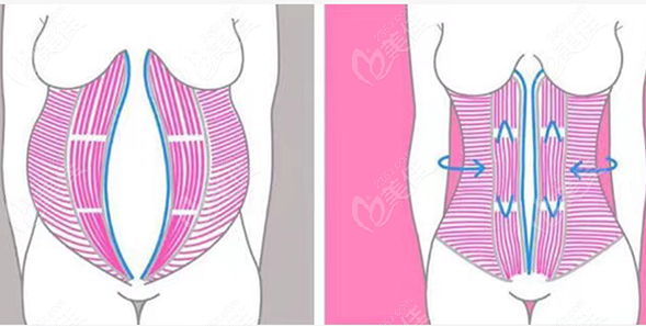 成都李獻(xiàn)和腹壁成行術(shù)怎么樣?四川現(xiàn)代醫(yī)院李獻(xiàn)和腹壁整形疤痕小疼痛感低  美佳網(wǎng)