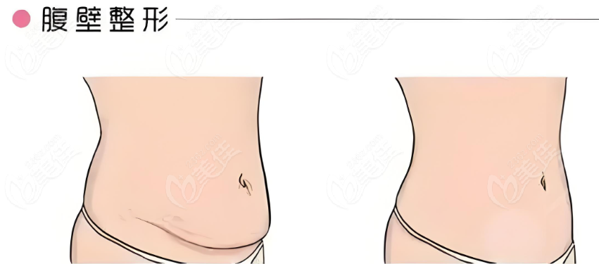 成都李獻(xiàn)和腹壁成行術(shù)怎么樣?四川現(xiàn)代醫(yī)院李獻(xiàn)和腹壁整形疤痕小疼痛感低