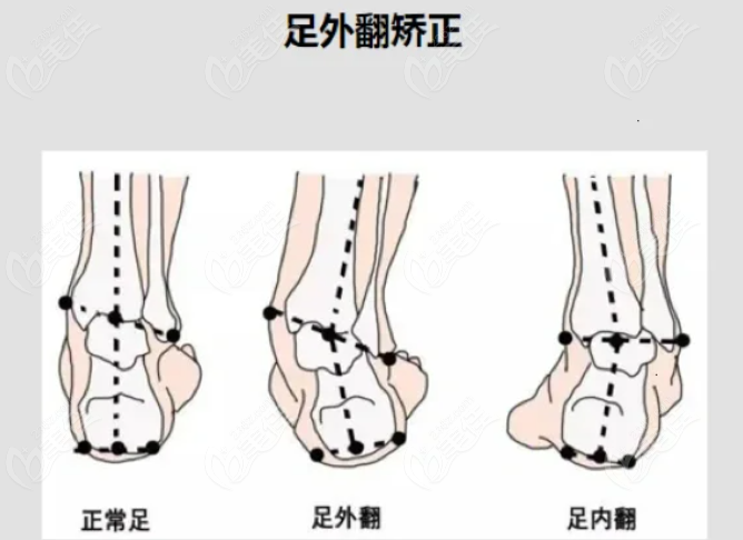 重庆足外翻矫正的价格是看情况的www.236z.com