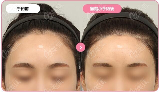 韩国MULY整形做额头缩小手术实例