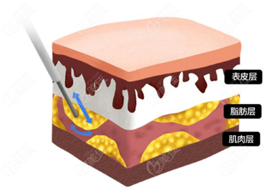 吸脂手术示意图