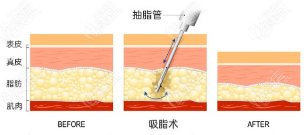 吸脂手术示意图