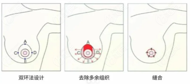 杭州美萊栗勇擅長縮胸