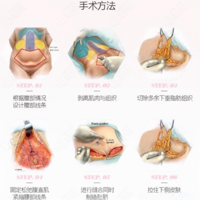 重庆松山医院做腹壁成形手术的原理