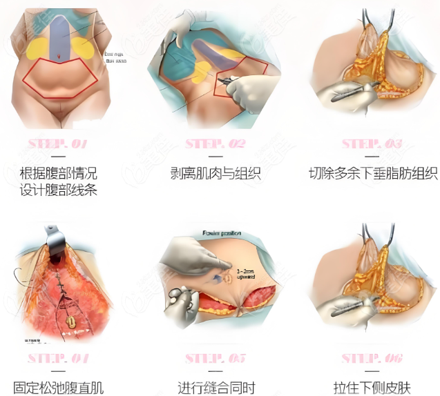 成都李献和腹壁成行术怎么样