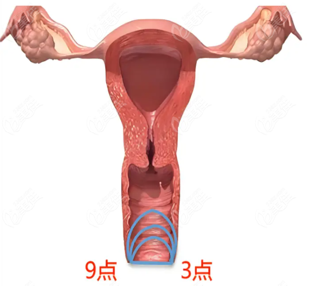 郑州市管城中医院3D生物束带阴道紧缩术