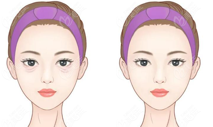 周云超修復(fù)眼袋疤痕不明顯療效很自然m.xqnp.cn
