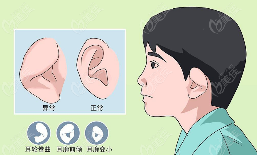 小耳畸形修复手术多少钱