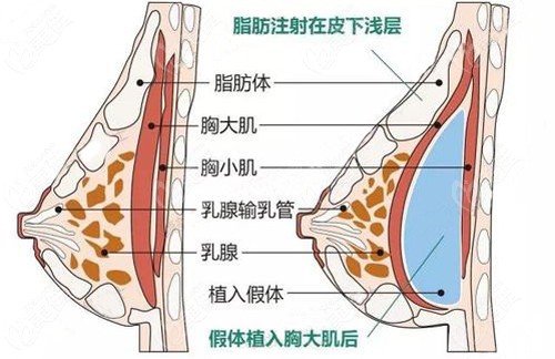 曹勇医生做复合式隆胸的技术好术后柔软