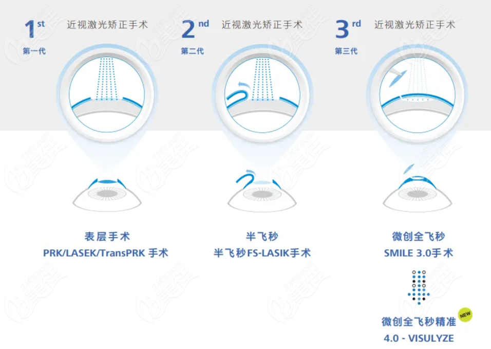 郑州尖峰眼科医院全飞秒4.0