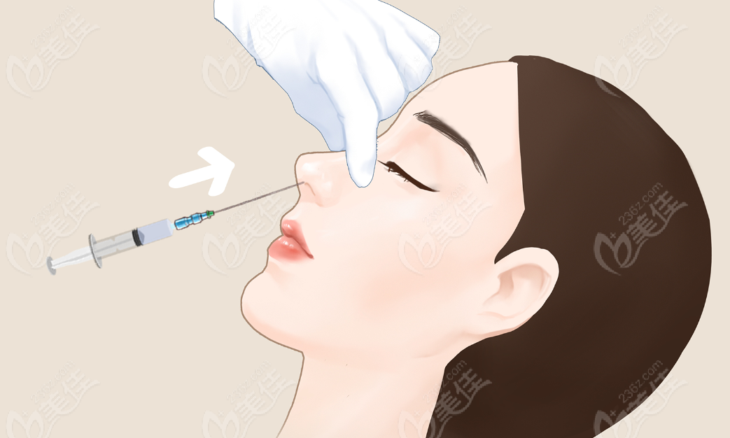 贝丽菲尔注射鼻子实例