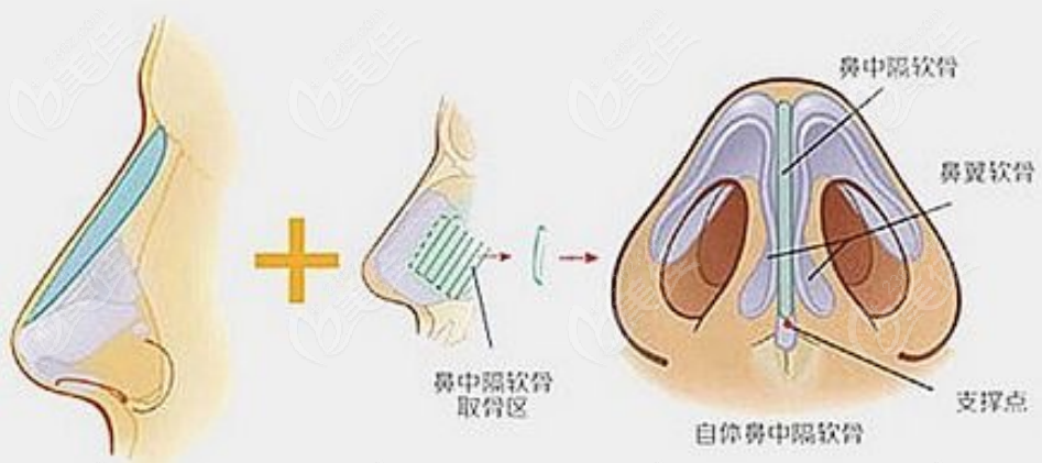 隆鼻示意图