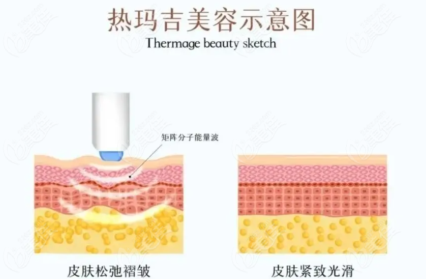 西安艺星医疗整形医院热玛吉
