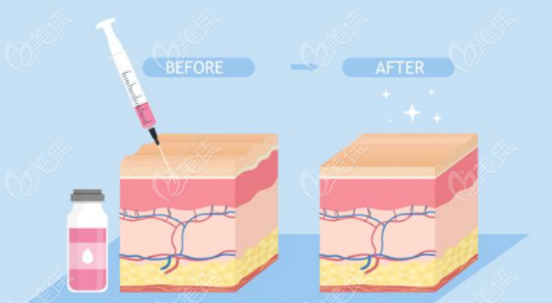 玻尿酸注射示意图