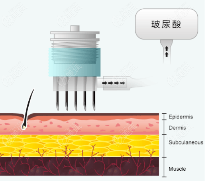 236z.com玻尿酸注射示意图