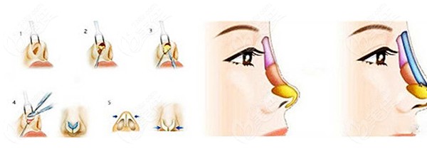 章小平做肋骨鼻修复的原理图