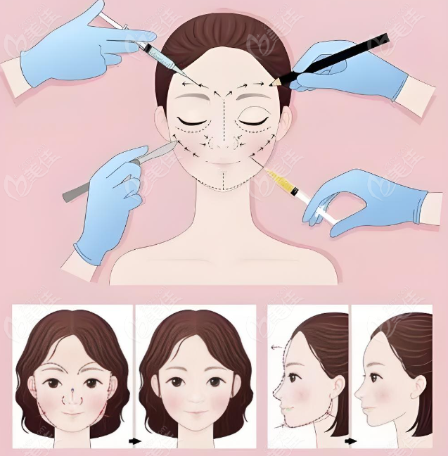 玻尿酸价格不同的原因 m.236z.com