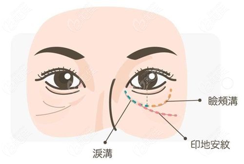 眼周注射薇旖美4mg胶原蛋白术前情况：