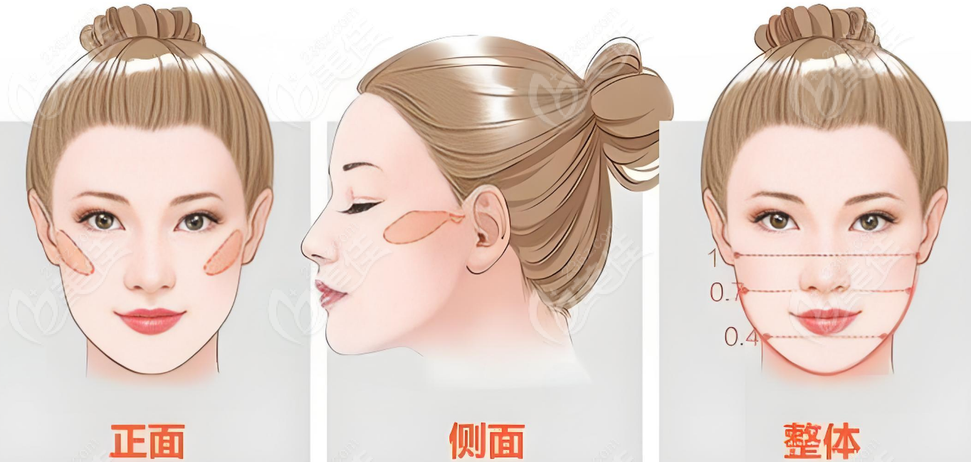 合肥韓美整形顴骨手術價格