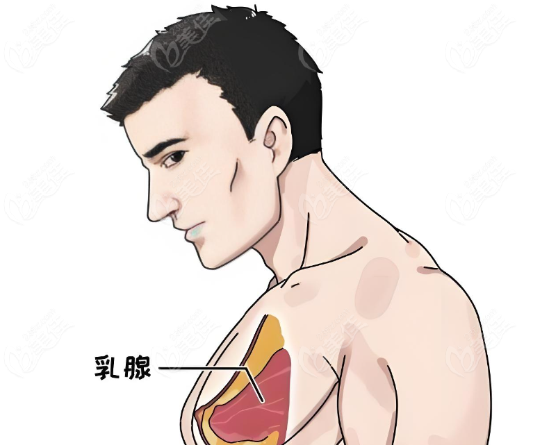 泰国隆胸手术过程