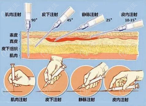赫萊麗玻尿酸