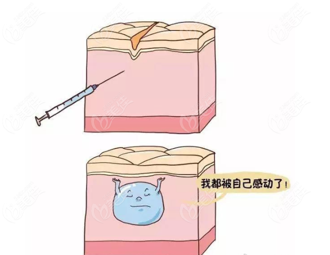 奥西施玻尿酸骨性支撑好