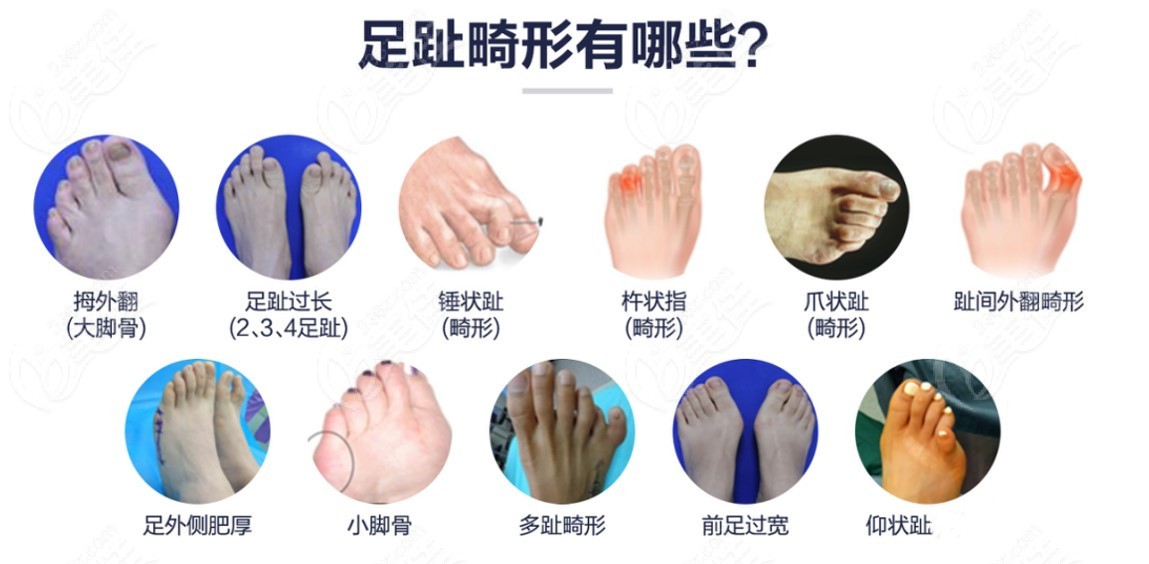 圣嘉新足雕足部整形好价格不贵