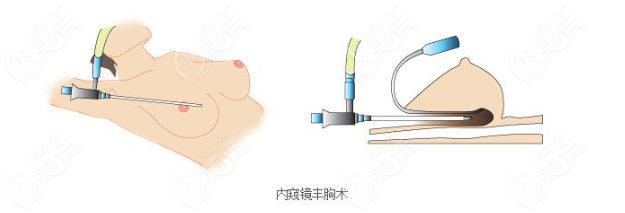 郑州赵亮医生隆胸怎么样啊