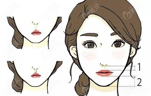 北京王晓健医生做人中做得好