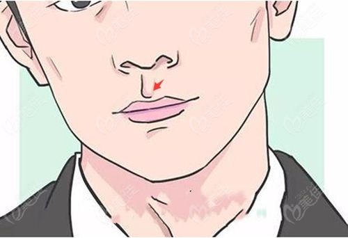 王晓健人中窝加深范例