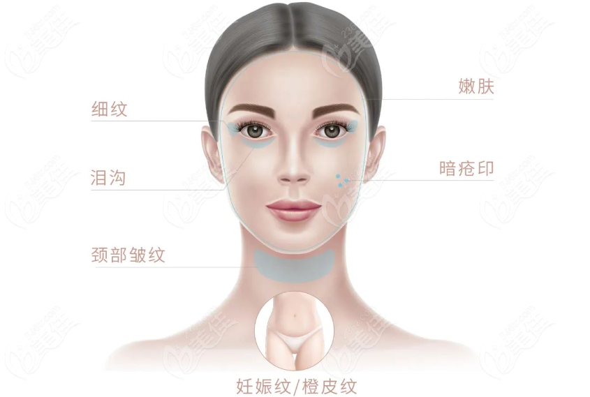 juvelook素颜针适用人群以及部位
