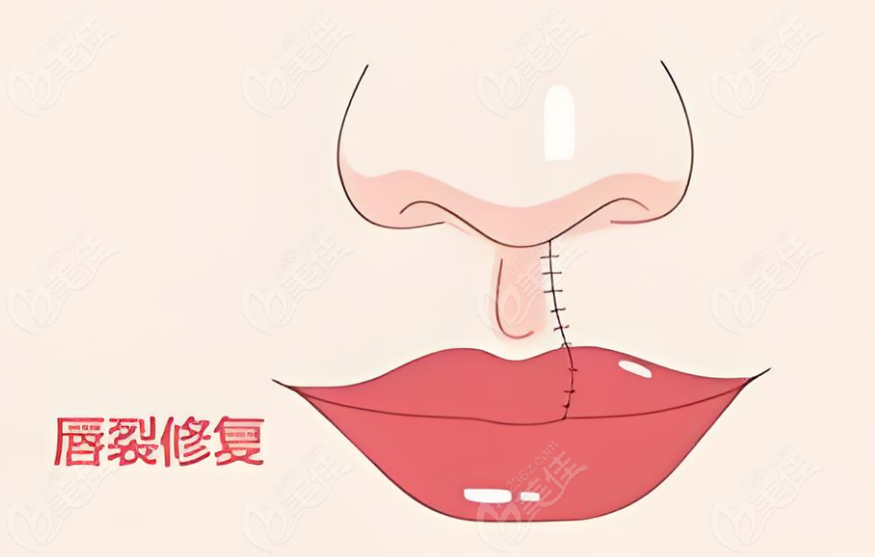 如何预约王明刚医生做唇裂修复