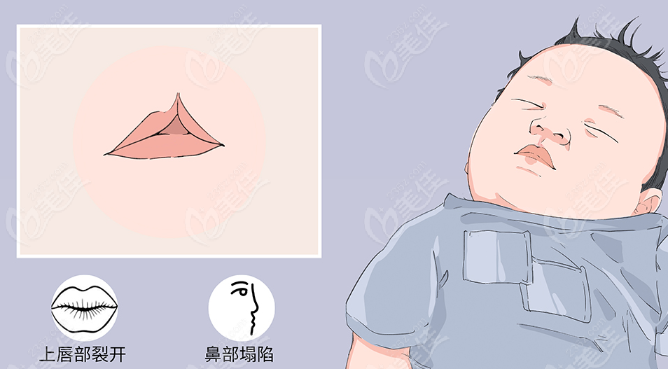 成都市西区医院卿勇唇腭裂修复做的好!医生简介+挂号流程详解 美佳网