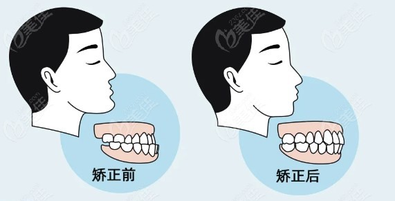 牙齿矫正