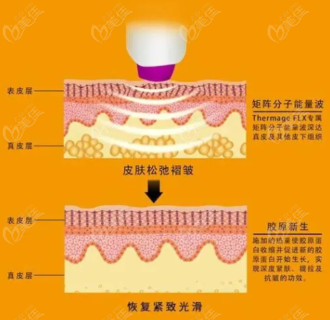 热玛吉