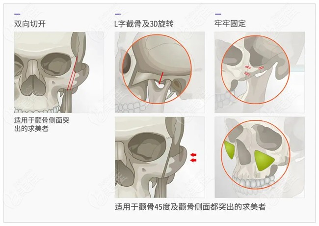 刘正茂做颧骨内推自然术后脸型有明显内收