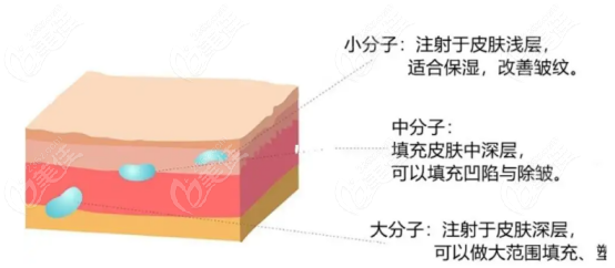 玻尿酸注射示意图