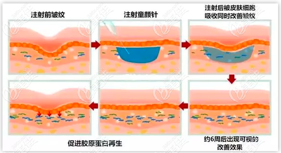 玻尿酸注射示意图