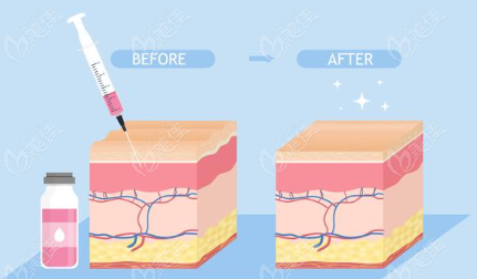 玻尿酸注射示意图